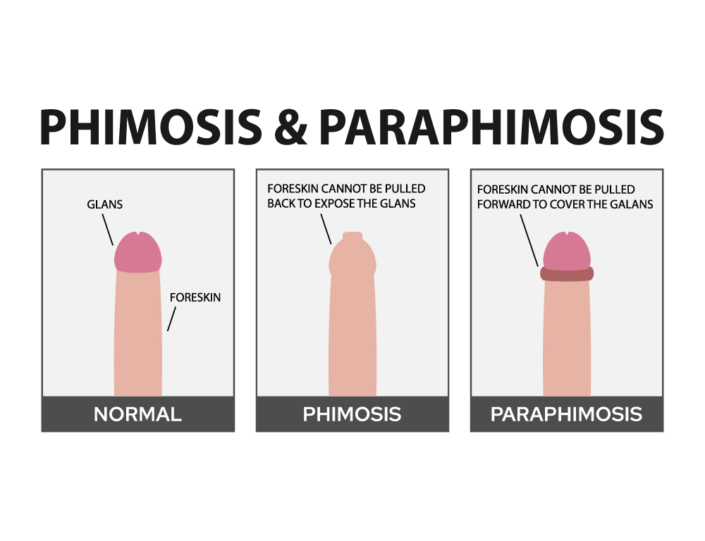 Tight foreskin problem: the 2 types of phimosis (physiological and ...